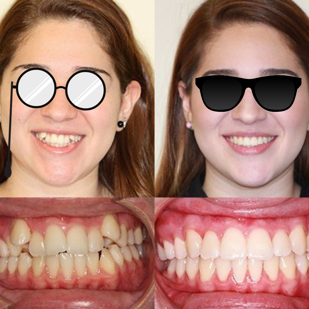 Clear aligners before and after