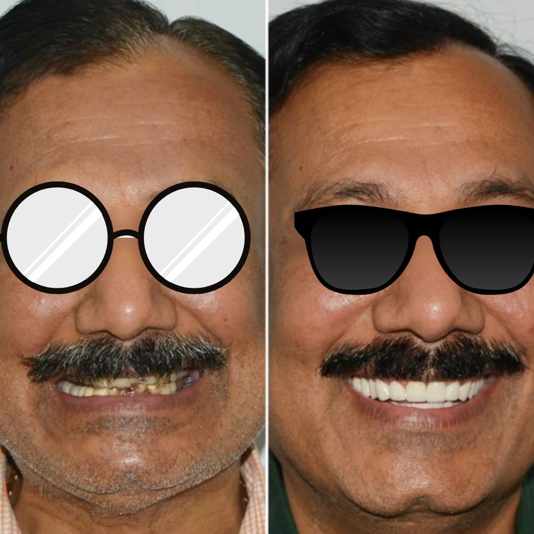 Full mouth rehabilitation before and after