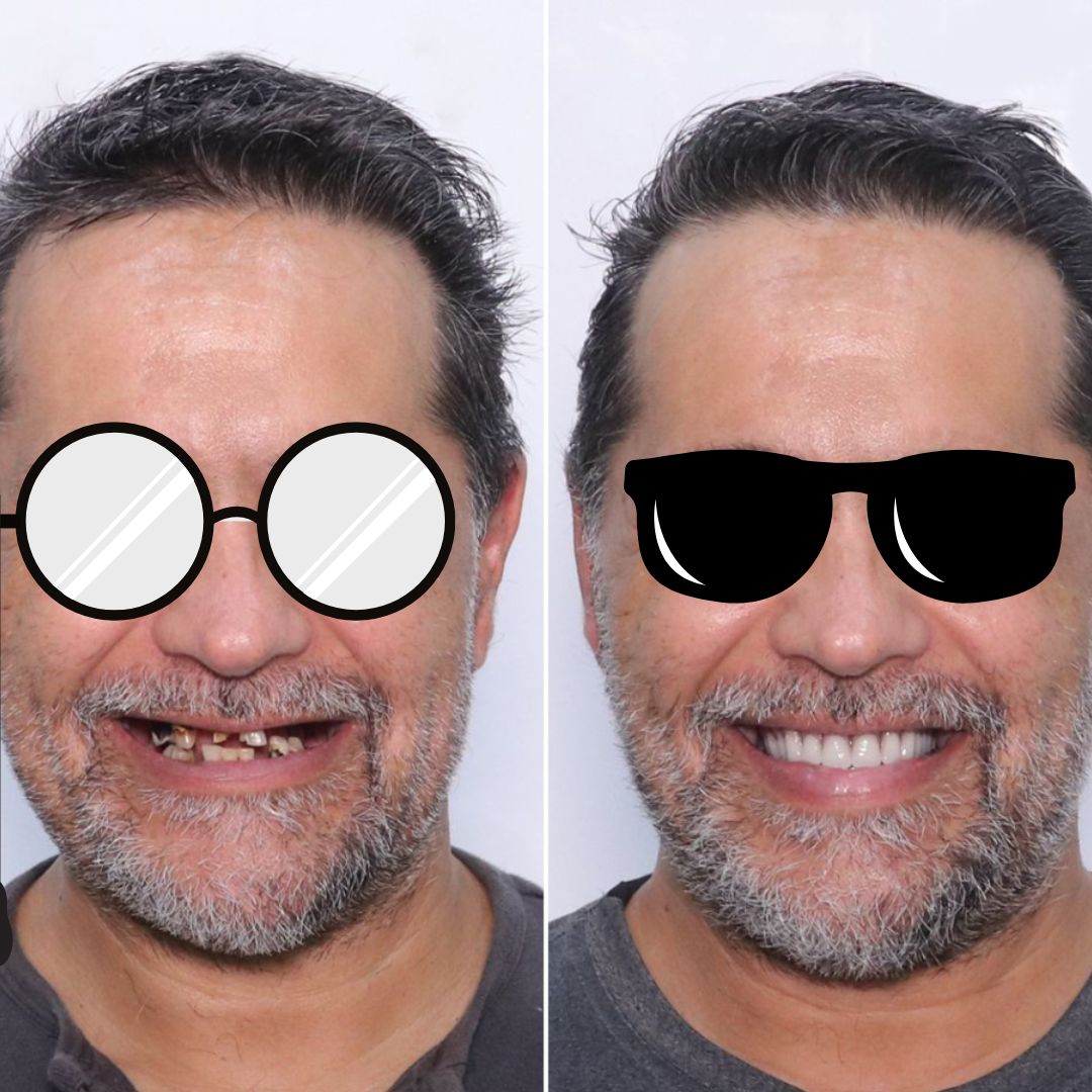 Dental implant before and after