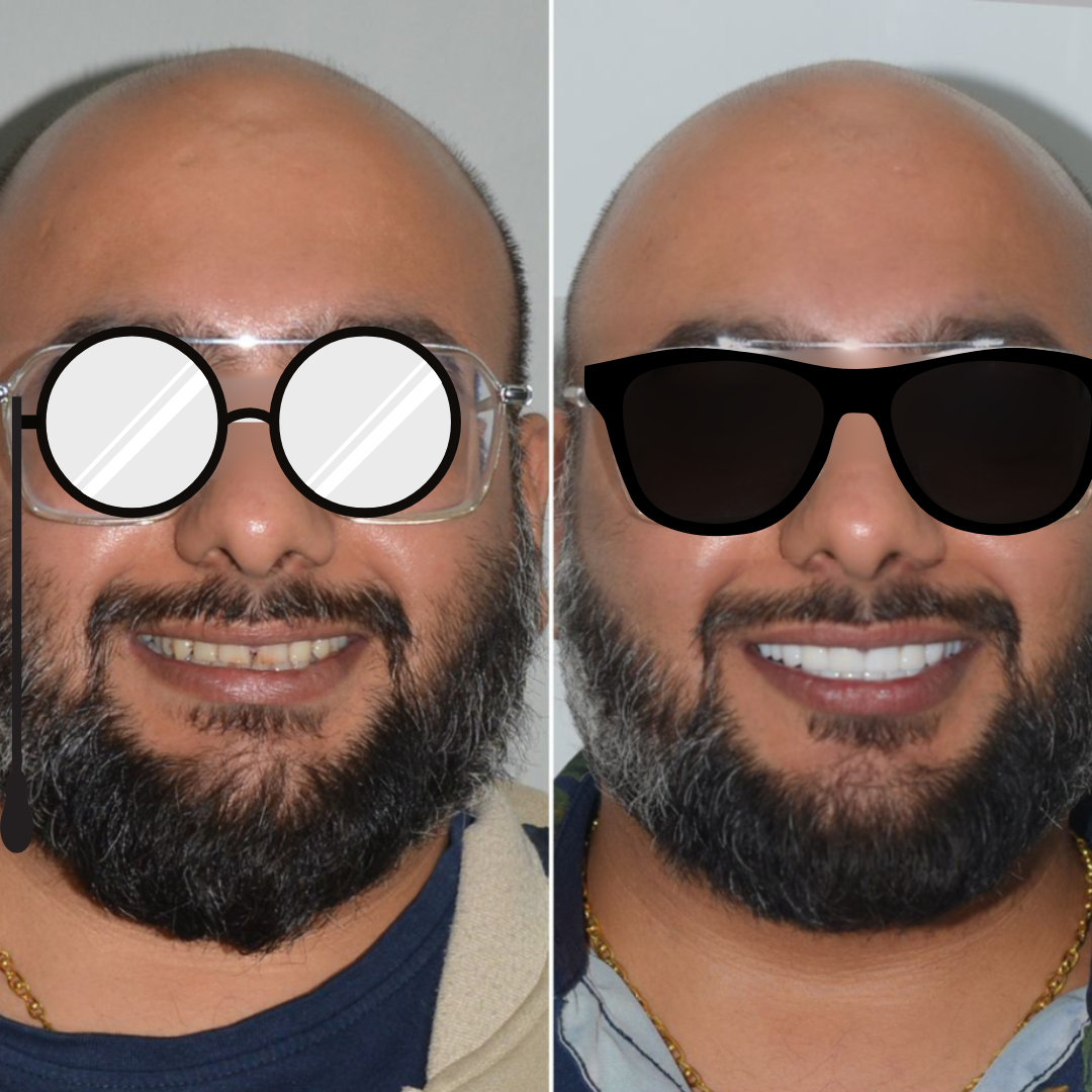 Teeth whitening and gap closure before and after