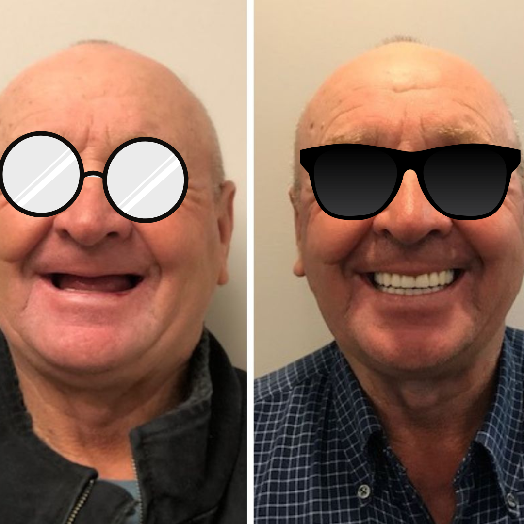 Dental implant before and after