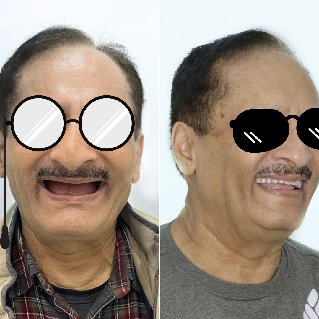 Dental implant before and after