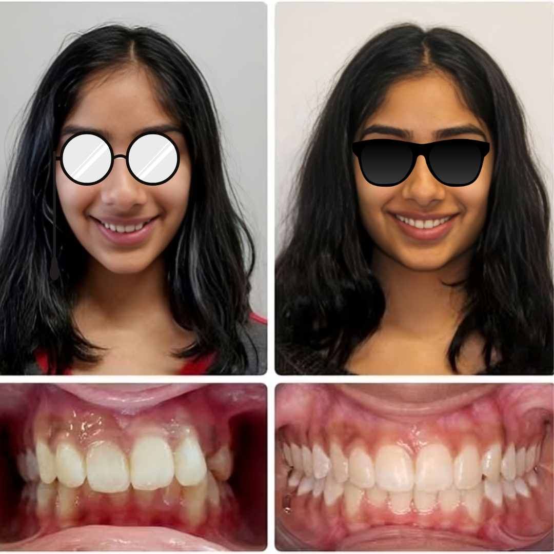 Clear aligners before and after