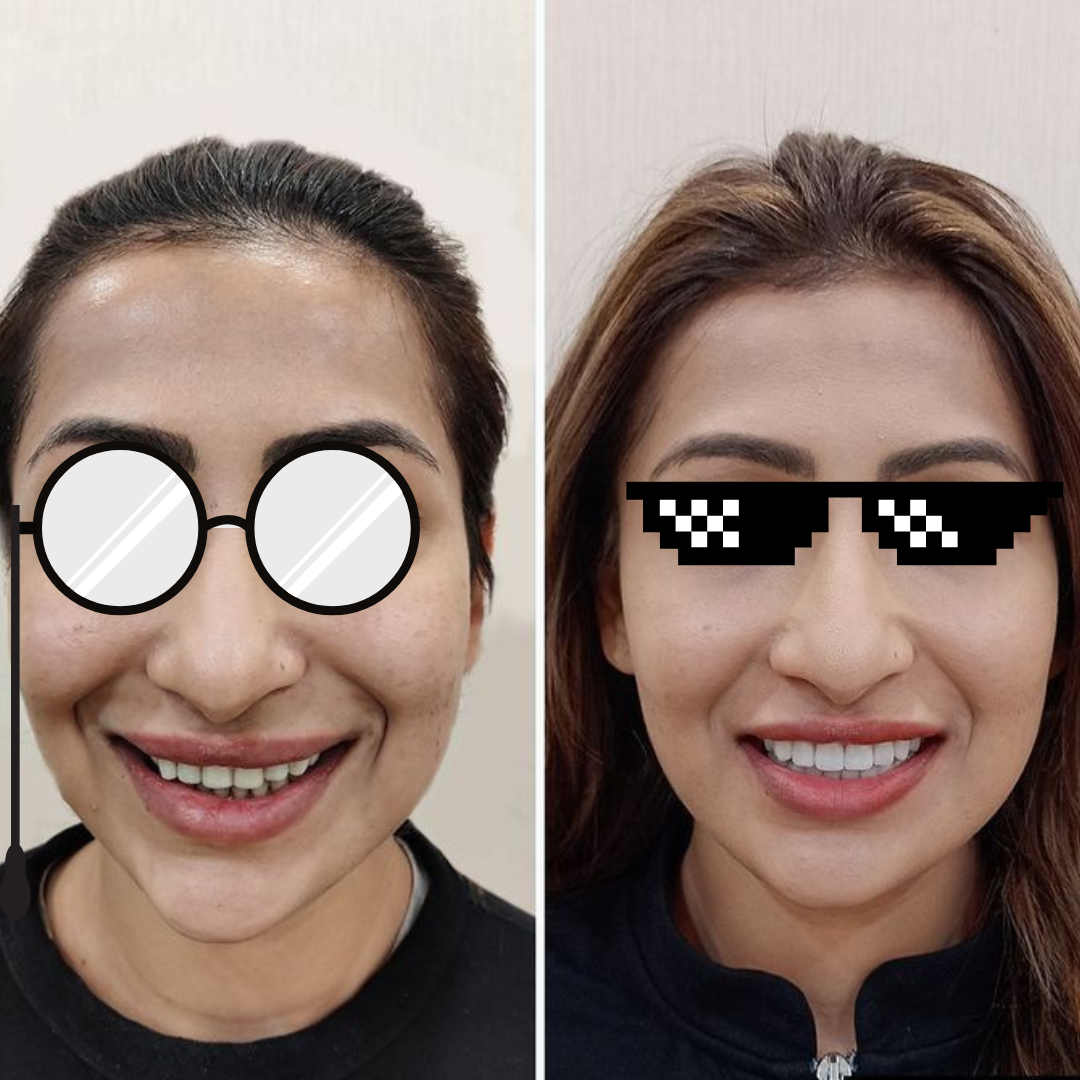 Smile makeover before and after