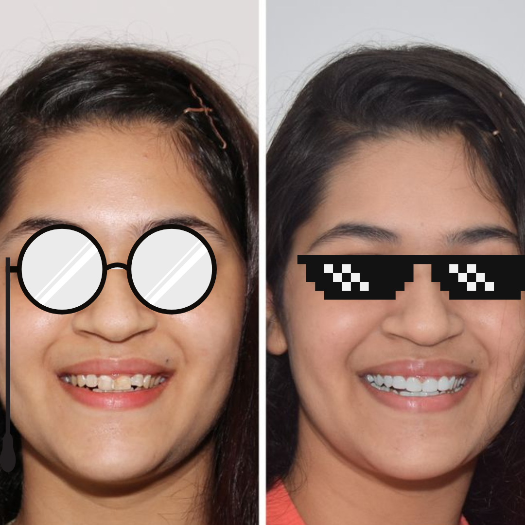 Smile makeover before and after