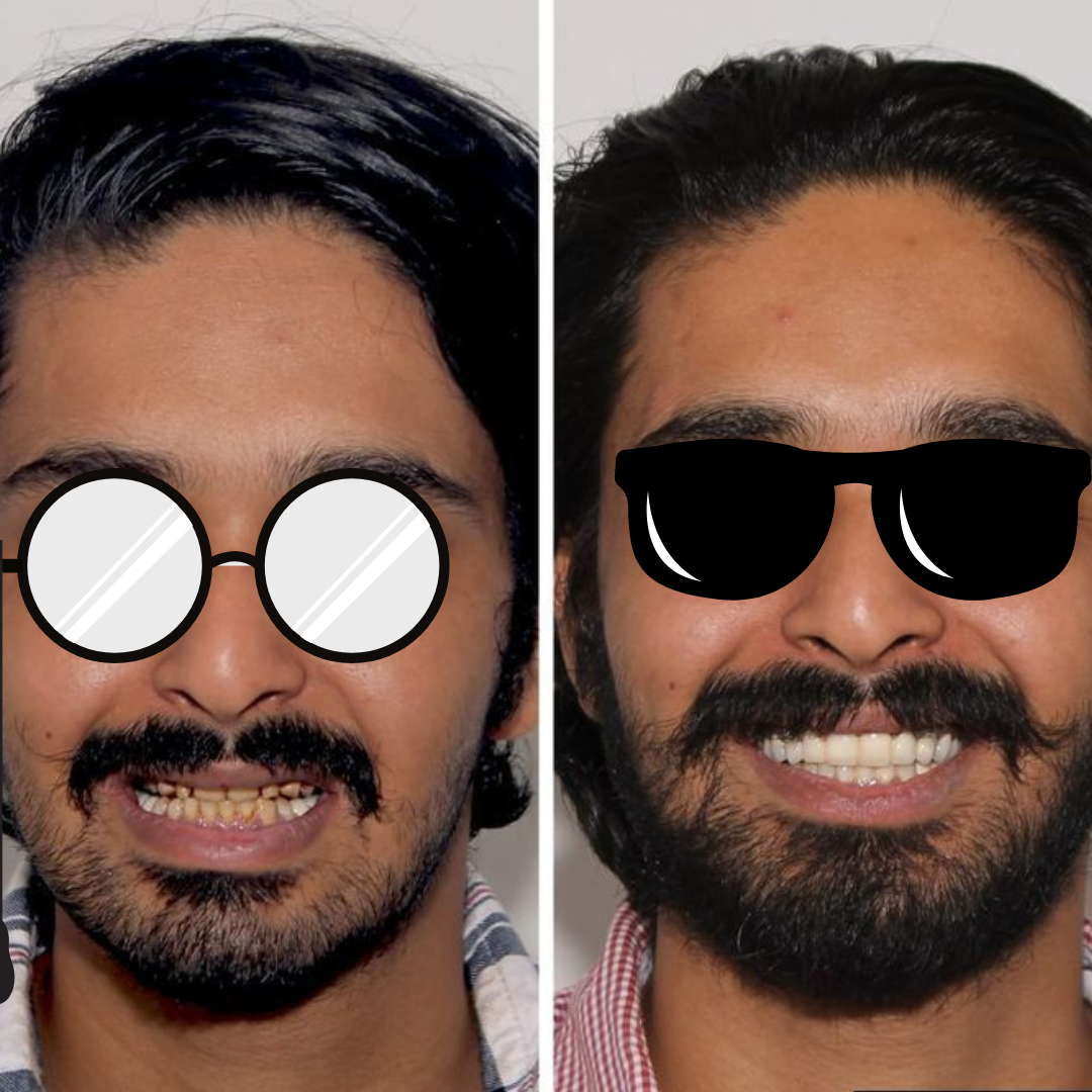 Smile makeover before and after
